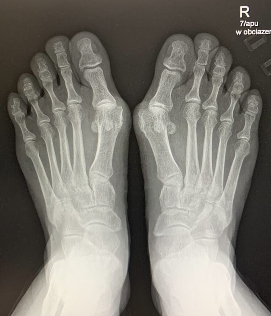 Konsultacja ortopedyczna stopy